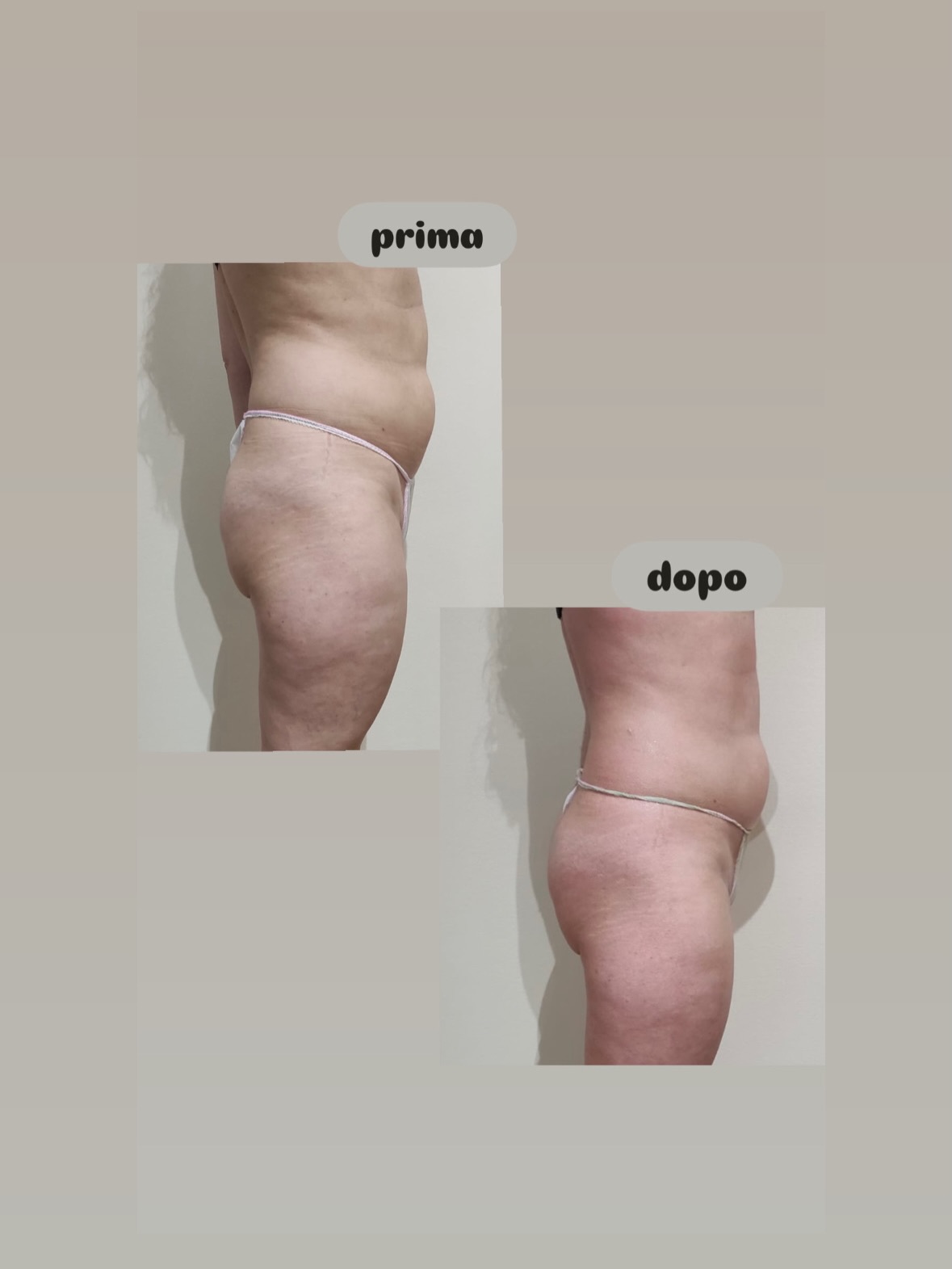 Risultato trattamento 2 – Vanità Estetic