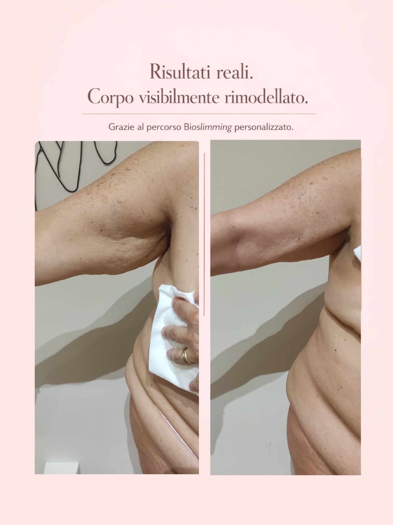 Risultato trattamento 4 – Vanità Estetic