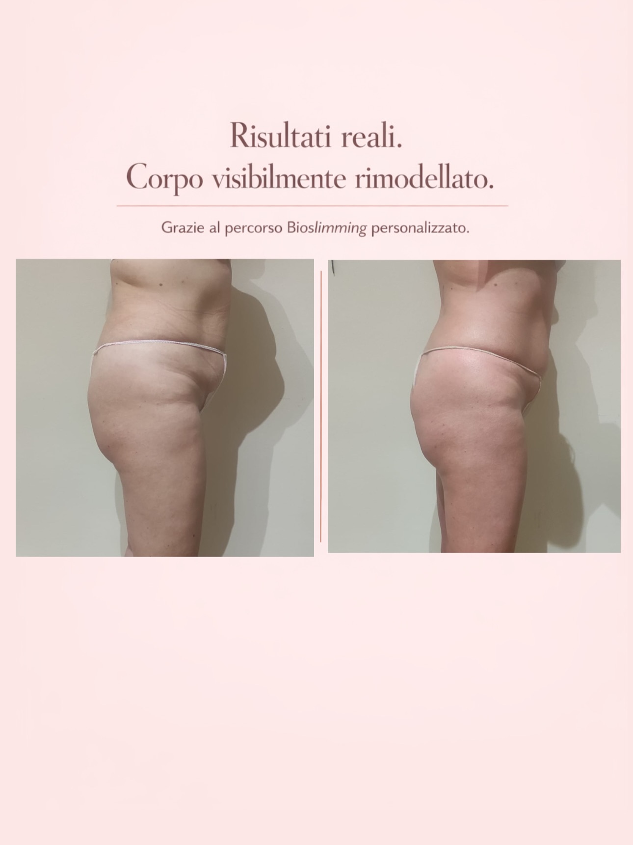 Risultato trattamento 6 – Vanità Estetic